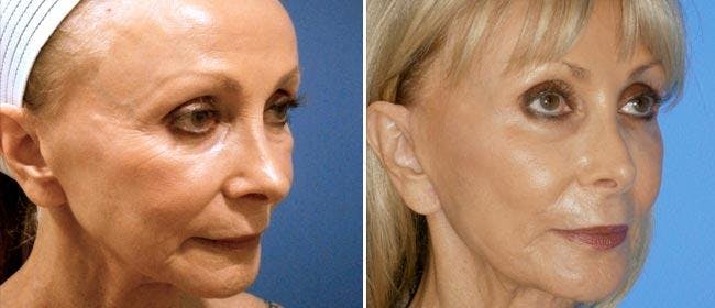 Facelift Before & After Gallery - Patient 38566803 - Image 2