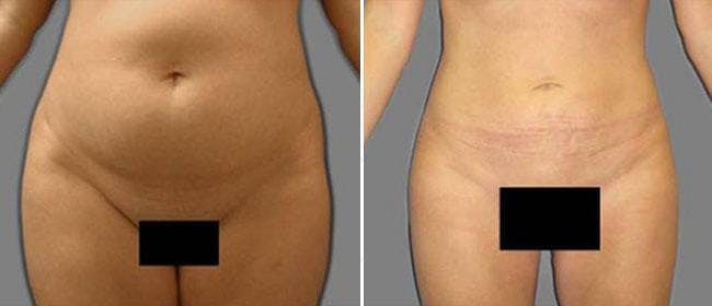 Liposuction Before & After Gallery - Patient 38566807 - Image 1