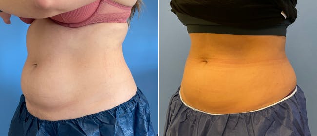 Coolsculpting Before & After Gallery - Patient 38566800 - Image 3