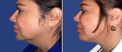 Neck Lift Before & After Gallery - Patient 38566809 - Image 1