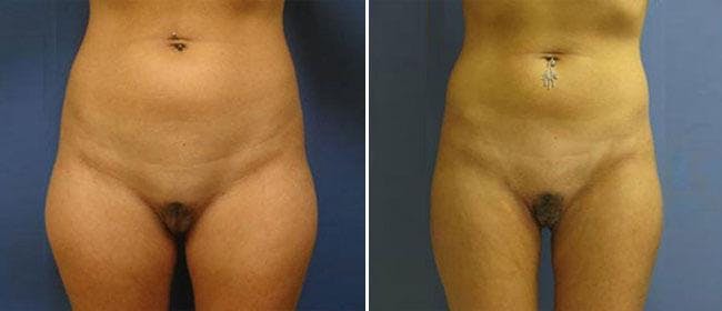 Liposuction Before & After Gallery - Patient 38566811 - Image 1