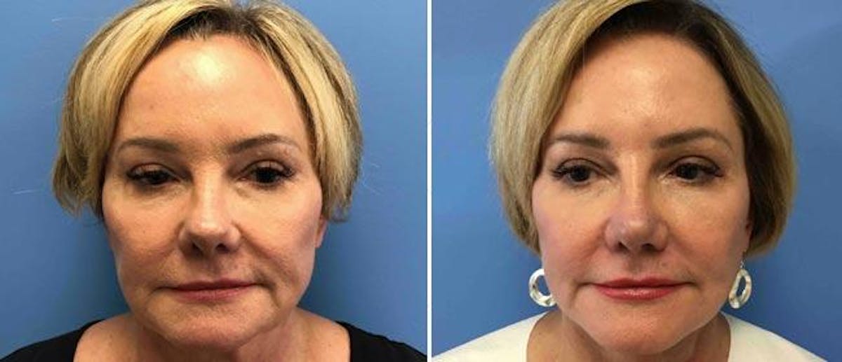 Facelift Before & After Gallery - Patient 38566812 - Image 1