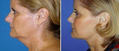 Neck Lift Before & After Gallery - Patient 38566813 - Image 1