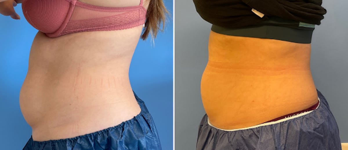 Coolsculpting Before & After Gallery - Patient 38566800 - Image 4
