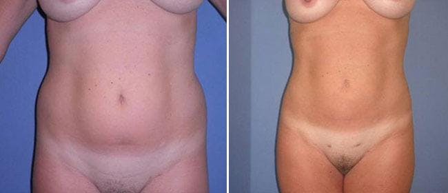 Liposuction Before & After Gallery - Patient 38566814 - Image 1
