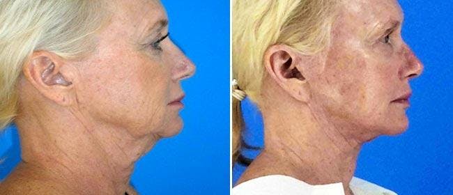 Neck Lift Before & After Gallery - Patient 38566816 - Image 1