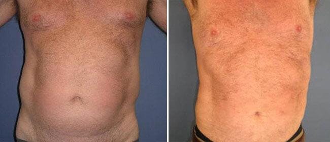 Liposuction Before & After Gallery - Patient 38566817 - Image 1