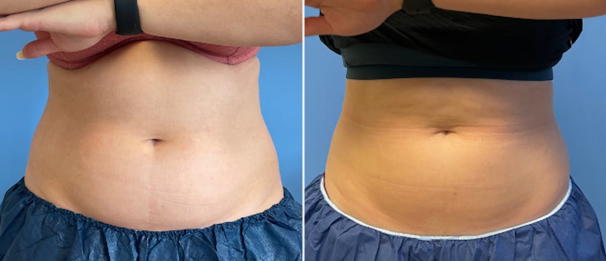 Coolsculpting Before & After Gallery - Patient 38566800 - Image 5