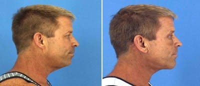 Neck Lift Before & After Gallery - Patient 38566818 - Image 1