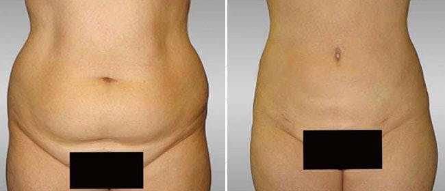 Liposuction Before & After Gallery - Patient 38566820 - Image 1