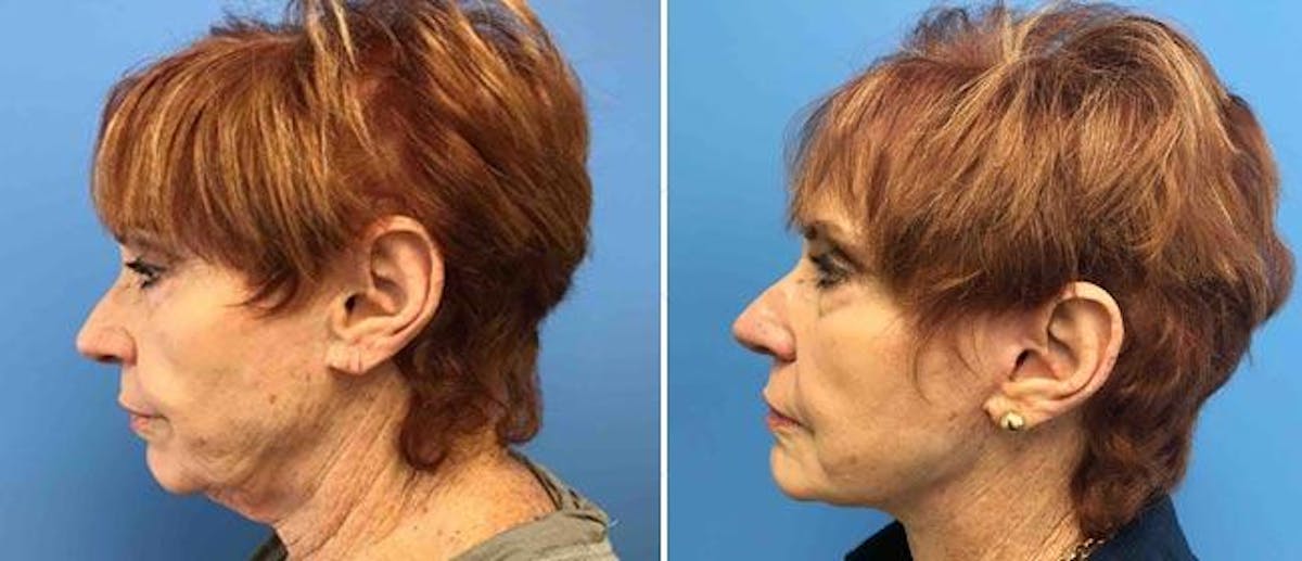 Neck Lift Before & After Gallery - Patient 38566821 - Image 1