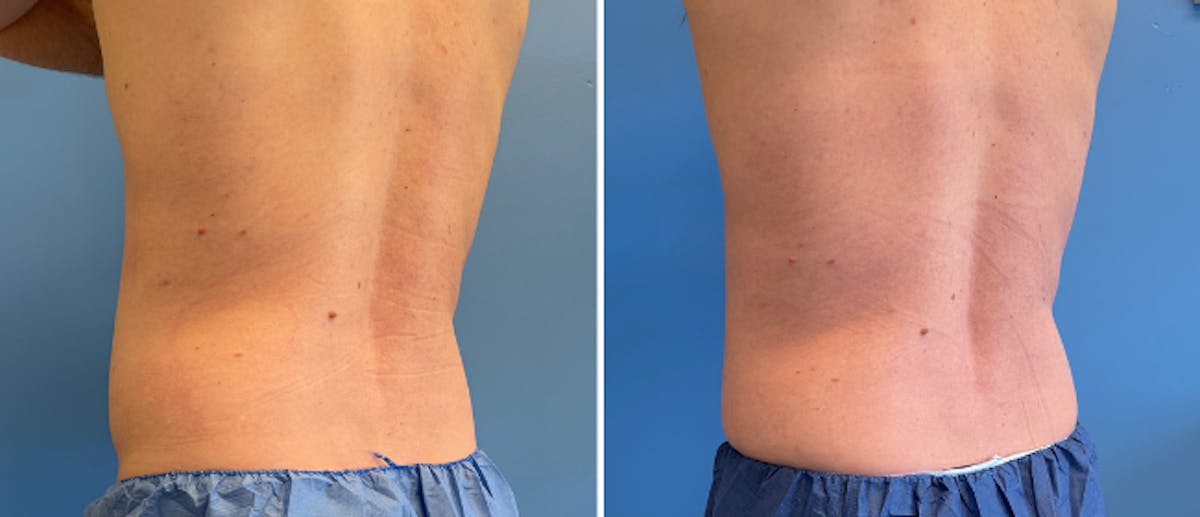Coolsculpting Before & After Gallery - Patient 38566822 - Image 1