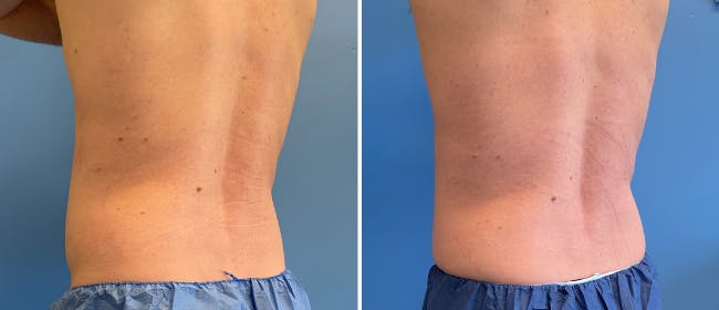 Coolsculpting Before & After Gallery - Patient 38566822 - Image 1