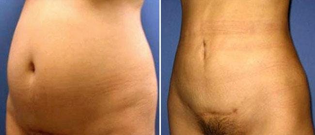 Liposuction Before & After Gallery - Patient 38566823 - Image 1
