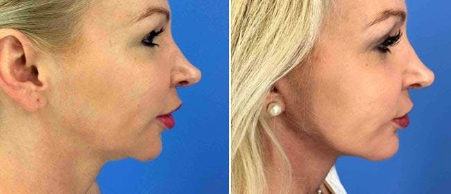 Neck Lift Before & After Gallery - Patient 38566824 - Image 1
