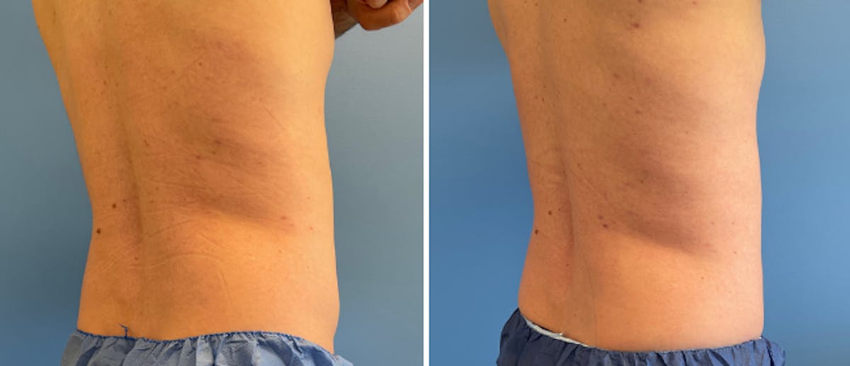 Coolsculpting Before & After Gallery - Patient 38566822 - Image 2