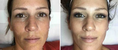 Cosmelan Peel Before & After Gallery - Patient 38566826 - Image 1