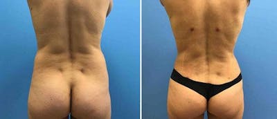 Liposuction Before & After Gallery - Patient 38566827 - Image 1