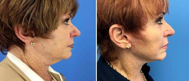 Neck Lift Before & After Gallery - Patient 38566821 - Image 2