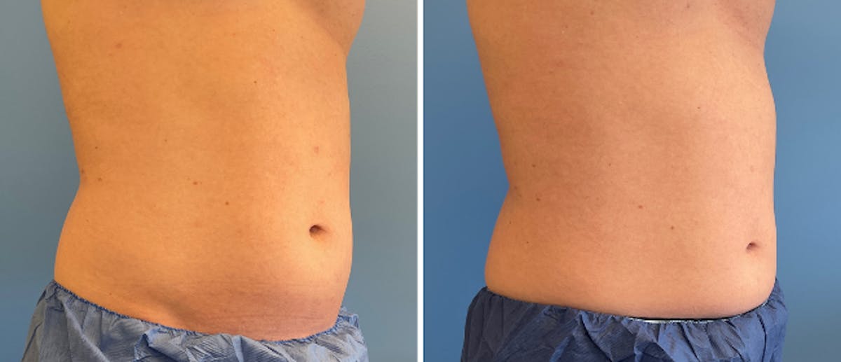 Coolsculpting Before & After Gallery - Patient 38566822 - Image 3