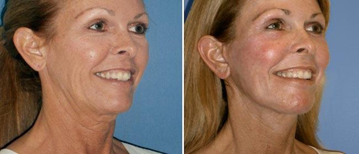 Neck Lift Before & After Gallery - Patient 38566831 - Image 1