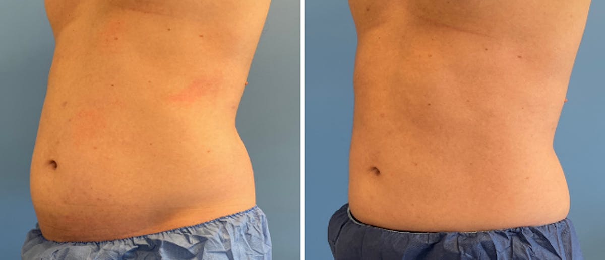 Coolsculpting Before & After Gallery - Patient 38566822 - Image 4