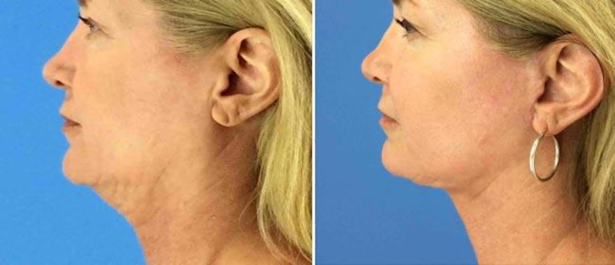 Neck Lift Before & After Gallery - Patient 38566834 - Image 1