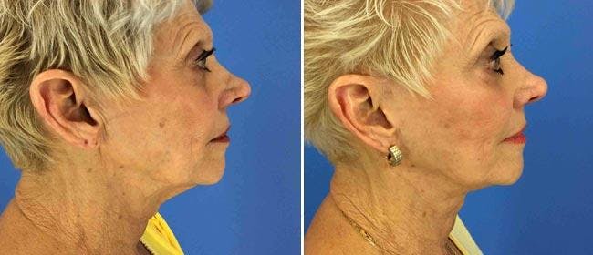 Neck Lift Before & After Gallery - Patient 38566837 - Image 1