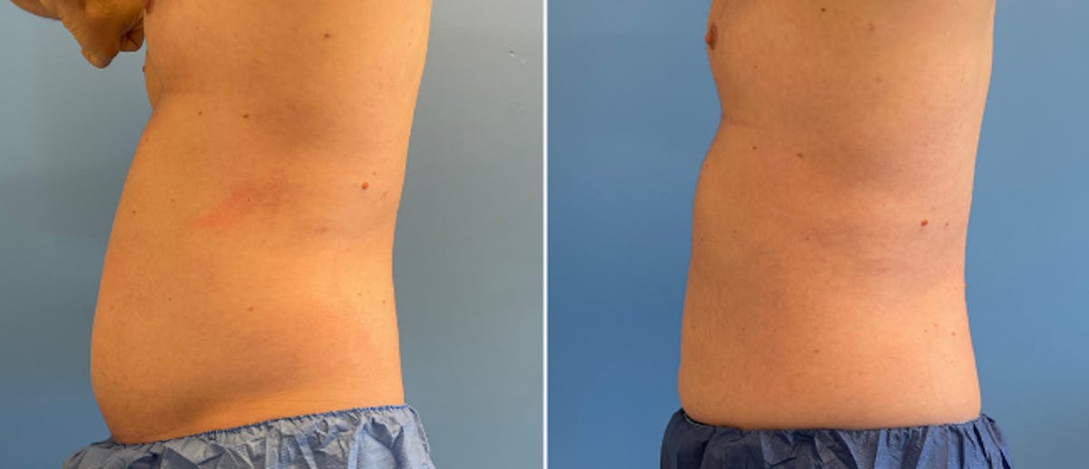 Coolsculpting Before & After Gallery - Patient 38566822 - Image 5