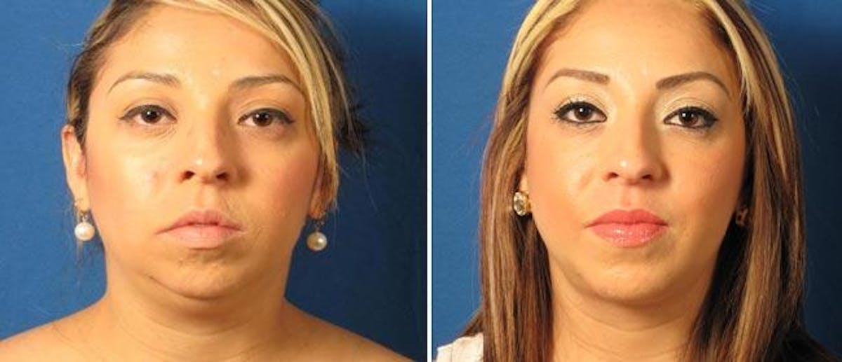 Liposuction Before & After Gallery - Patient 38566839 - Image 1