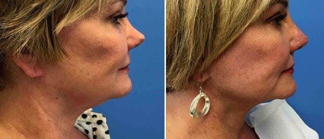Neck Lift Before & After Gallery - Patient 38566840 - Image 1