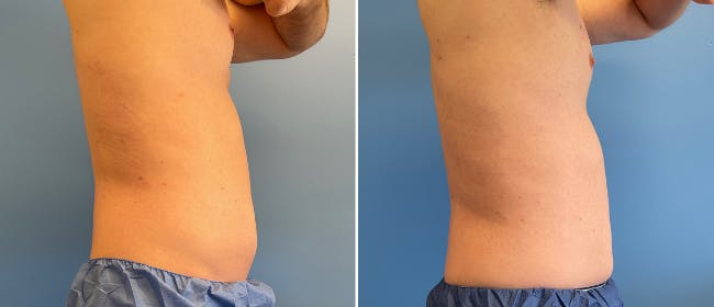 Coolsculpting Before & After Gallery - Patient 38566822 - Image 6