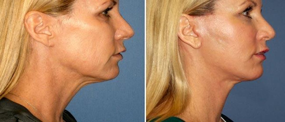 Neck Lift Before & After Gallery - Patient 38566843 - Image 1