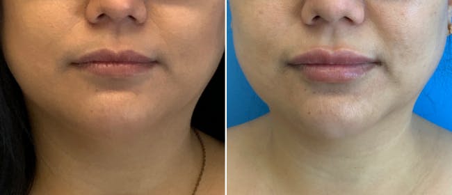 Dermal Fillers Before & After Gallery - Patient 38566844 - Image 1