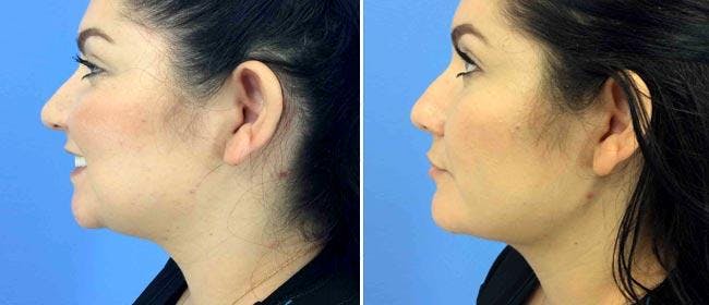 Liposuction Before & After Gallery - Patient 38566845 - Image 1