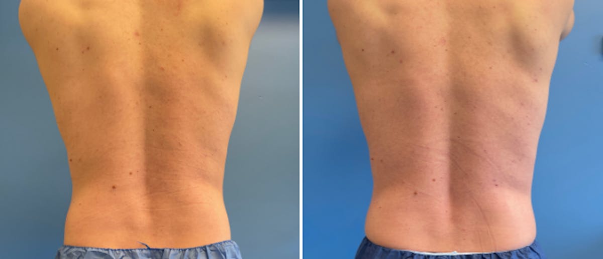 Coolsculpting Before & After Gallery - Patient 38566822 - Image 7