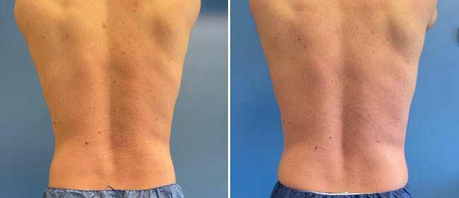 Coolsculpting Before & After Gallery - Patient 38566822 - Image 7