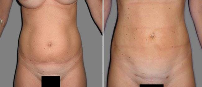 Liposuction Before & After Gallery - Patient 38566848 - Image 1