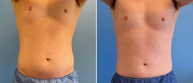 Coolsculpting Before & After Gallery - Patient 38566822 - Image 8