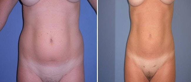 Liposuction Before & After Gallery - Patient 38566851 - Image 1