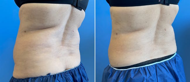 Coolsculpting Before & After Gallery - Patient 38566853 - Image 1