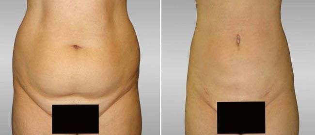Liposuction Before & After Gallery - Patient 38566854 - Image 1