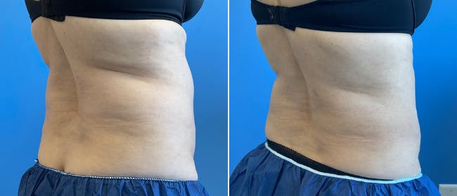 Coolsculpting Before & After Gallery - Patient 38566853 - Image 3