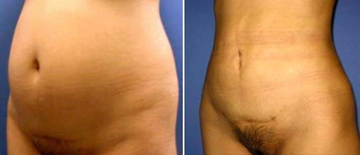 Liposuction Before & After Gallery - Patient 38566856 - Image 1