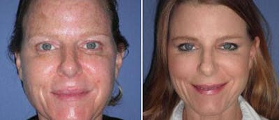 Dermal Fillers Before & After Gallery - Patient 38566857 - Image 1