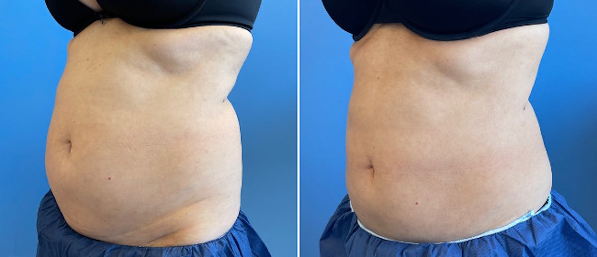 Coolsculpting Before & After Gallery - Patient 38566853 - Image 4