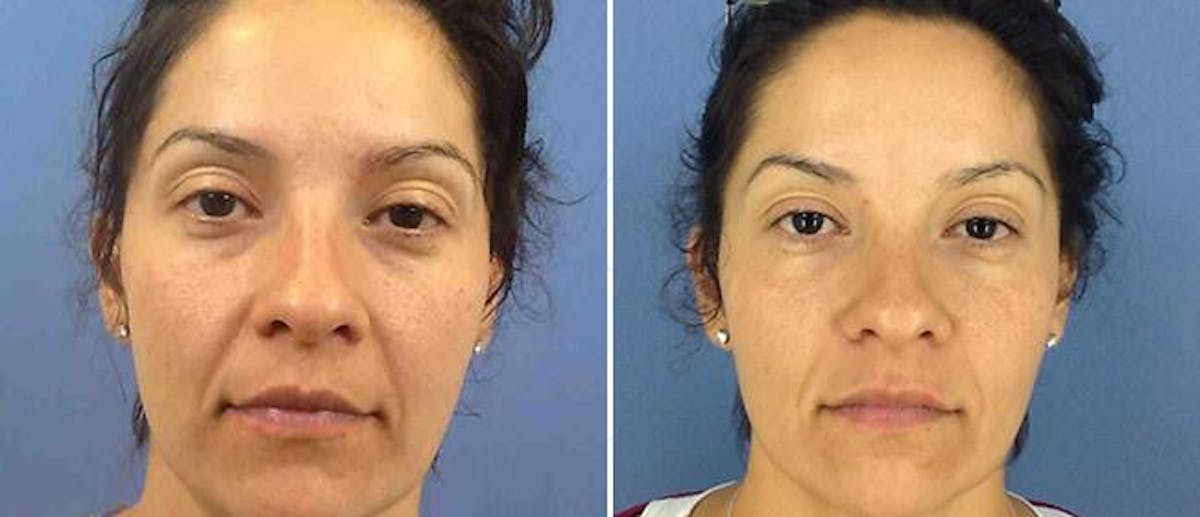 Dermal Fillers Before & After Gallery - Patient 38566859 - Image 1