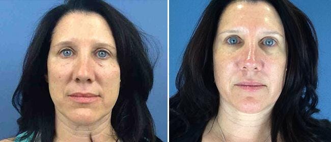 Dermal Fillers Before & After Gallery - Patient 38566861 - Image 1