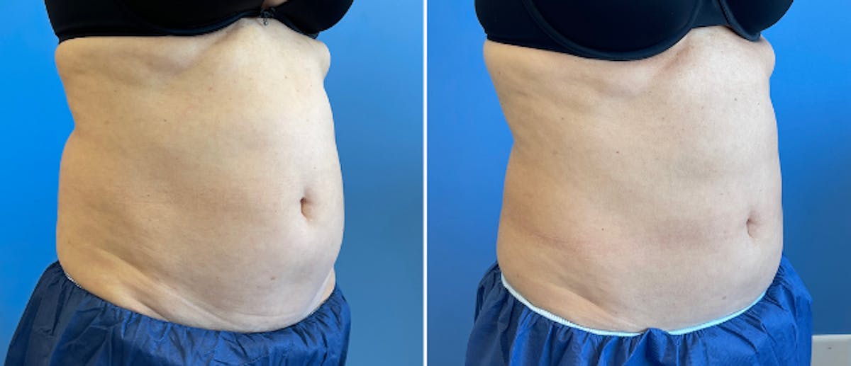Coolsculpting Before & After Gallery - Patient 38566853 - Image 5