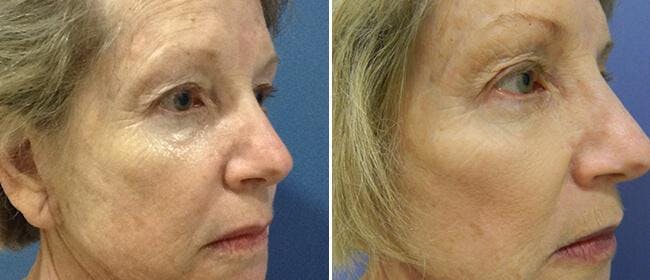 Dermal Fillers Before & After Gallery - Patient 38566863 - Image 1